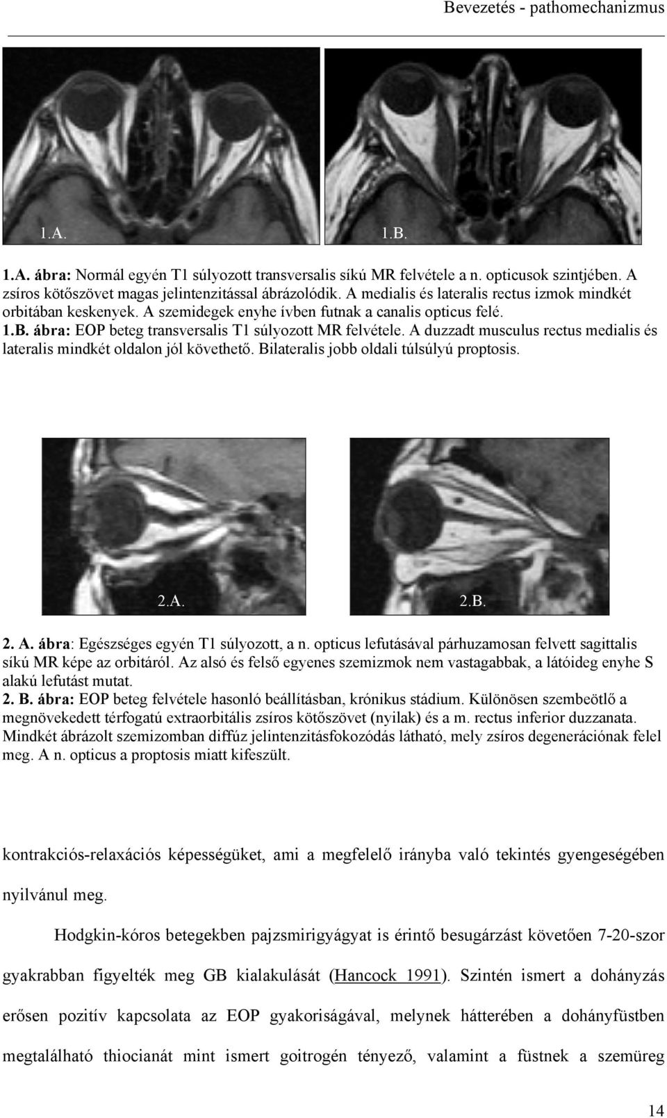 A duzzadt musculus ectus medialis és latealis mindkét oldalon jól követhet. Bilatealis jobb oldali túlsúlyú otosis. 2.A. 2.B. 2. A. ába: Egészséges egyén T1 súlyozott, a n.