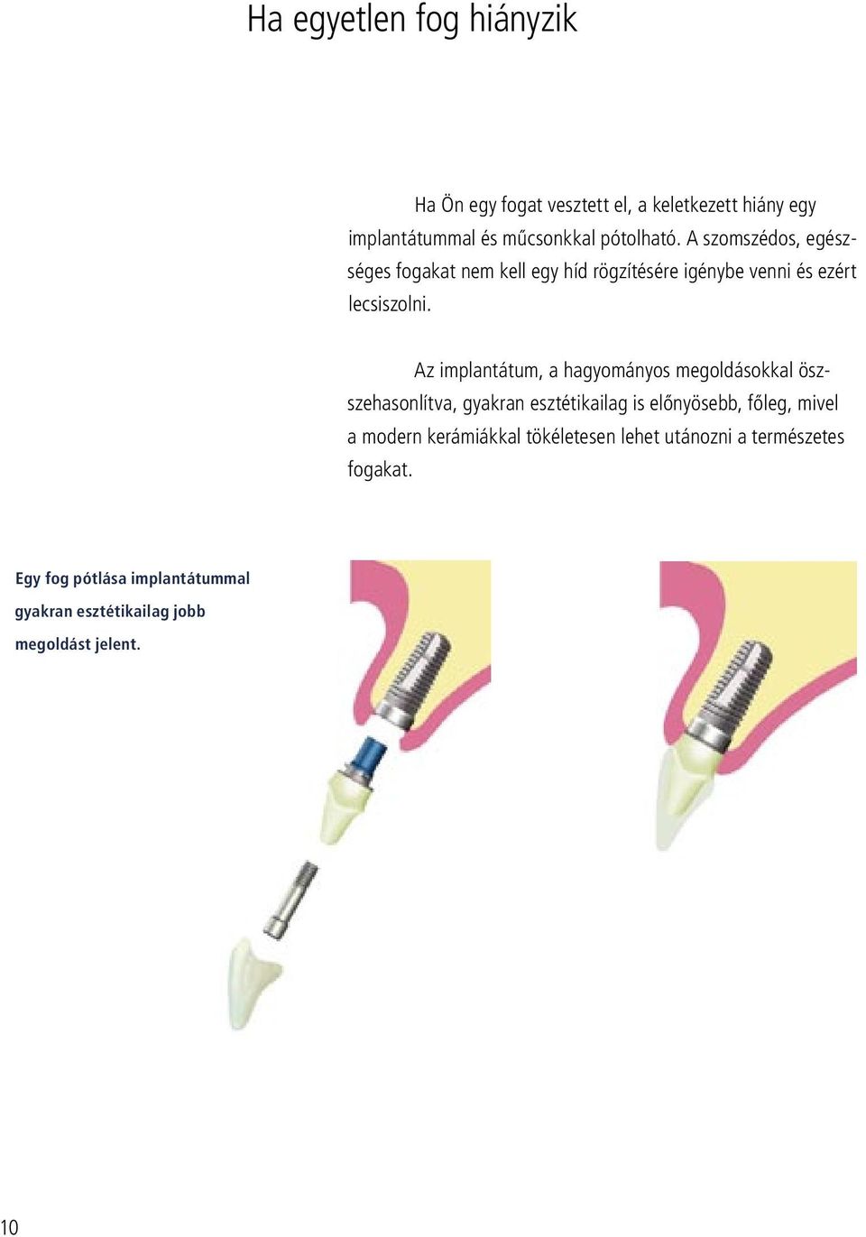 Az implantátum, a hagyományos megoldásokkal öszszehasonlítva, gyakran esztétikailag is elônyösebb, fôleg, mivel a