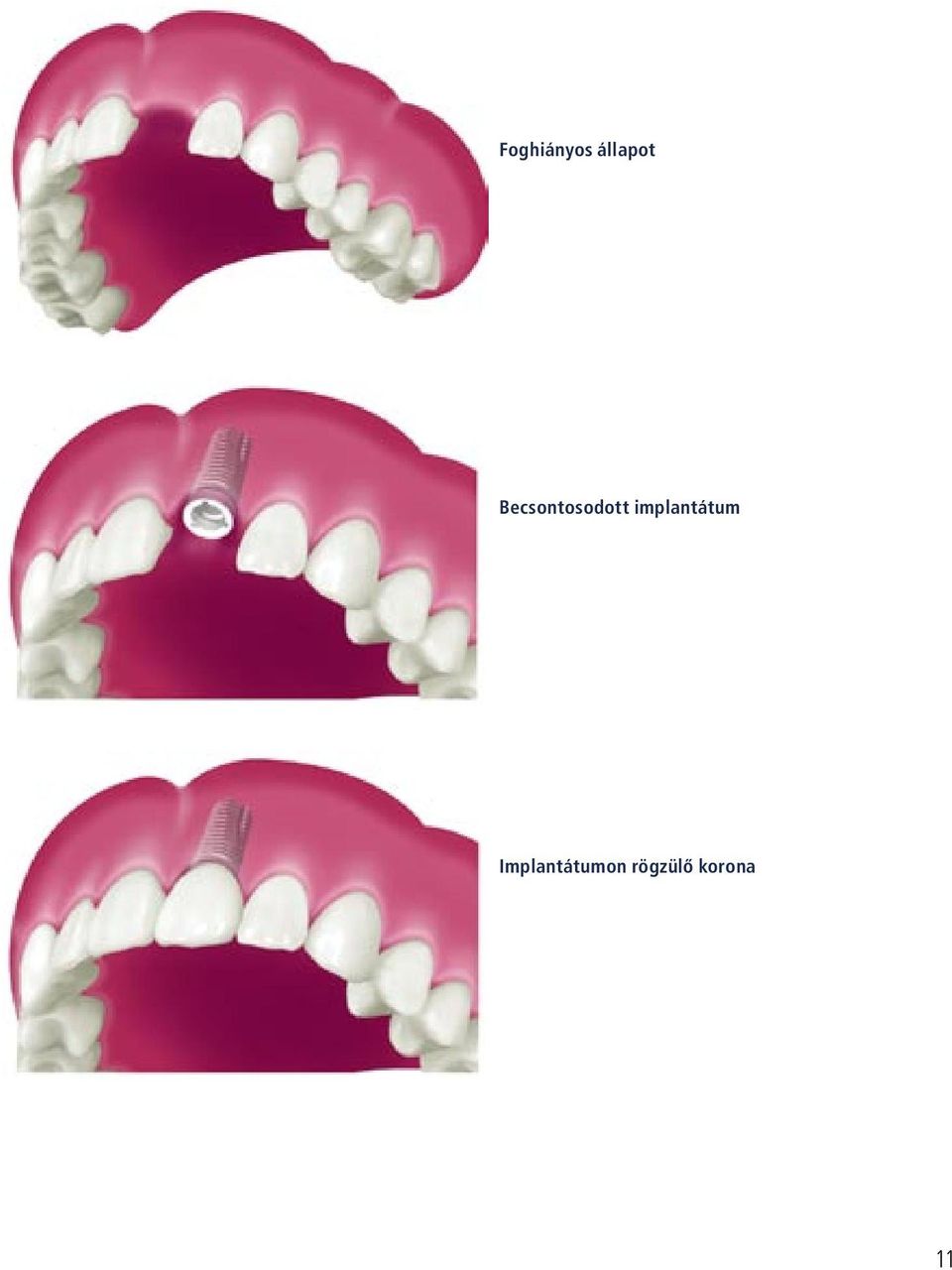 implantátum