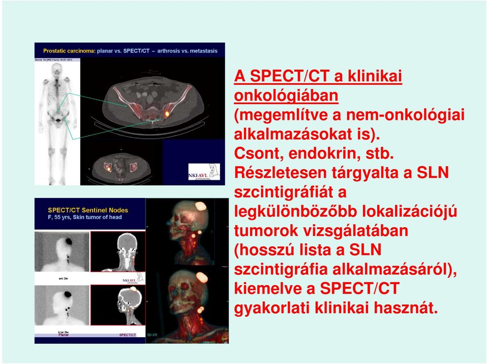 Részletesen tárgyalta a SLN szcintigráfiát a legkülönbözőbb lokalizációjú