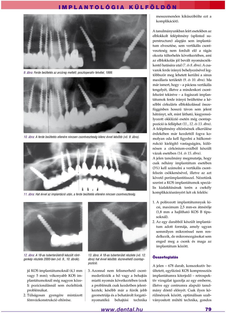 A tanulmányunkban leírt esetekben az elblokkolt felépítmény (splinted superstructure) alapján sem implantátum elvesztése, sem vertikális csontveszteség nem fordult elô a rágás okozta túlterhelés