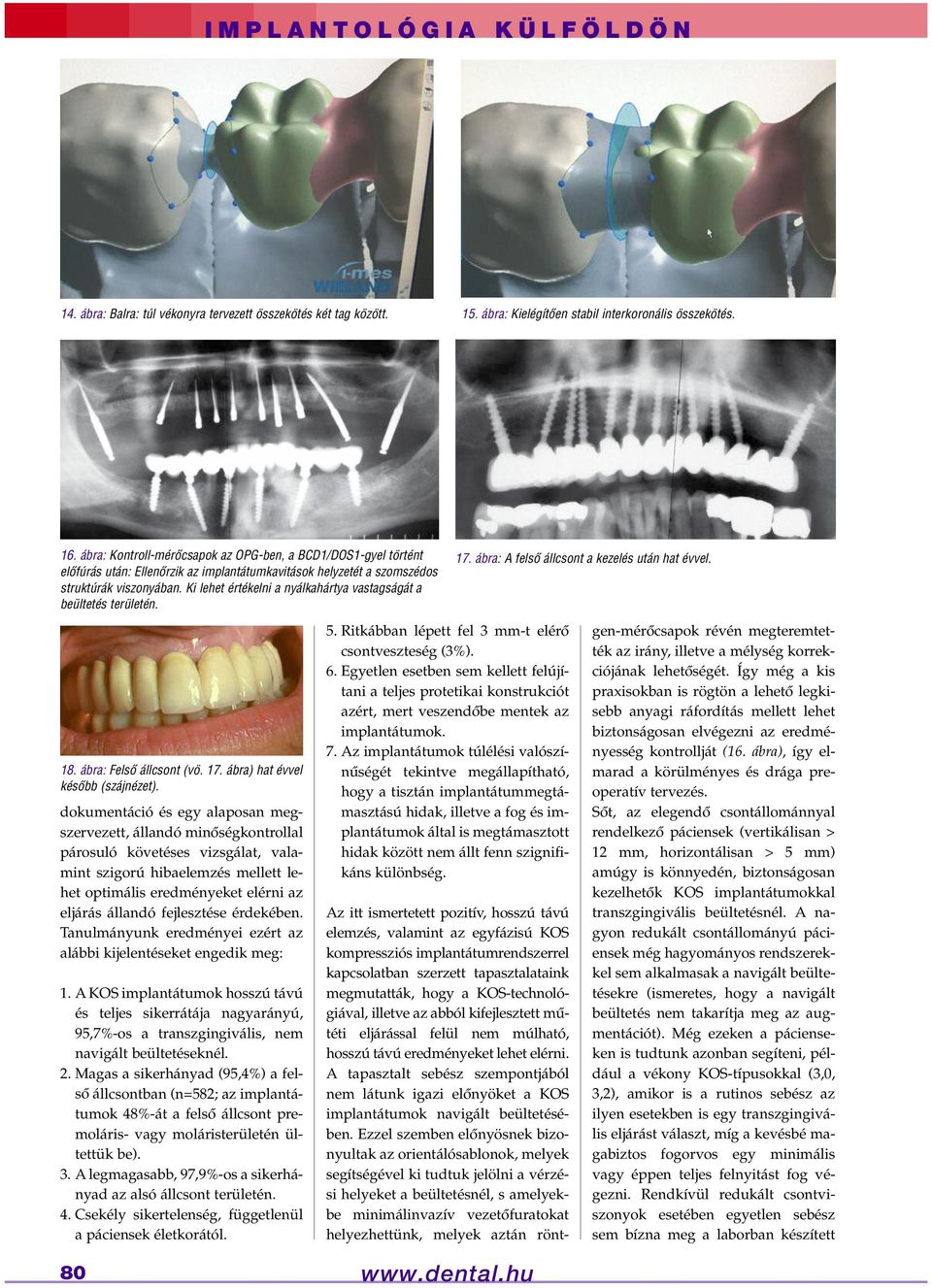 Ki lehet értékelni a nyálkahártya vastagságát a beültetés területén. 17. ábra: A felsô állcsont a kezelés után hat évvel. 18. ábra: Felsô állcsont (vö. 17. ábra) hat évvel késôbb (szájnézet).