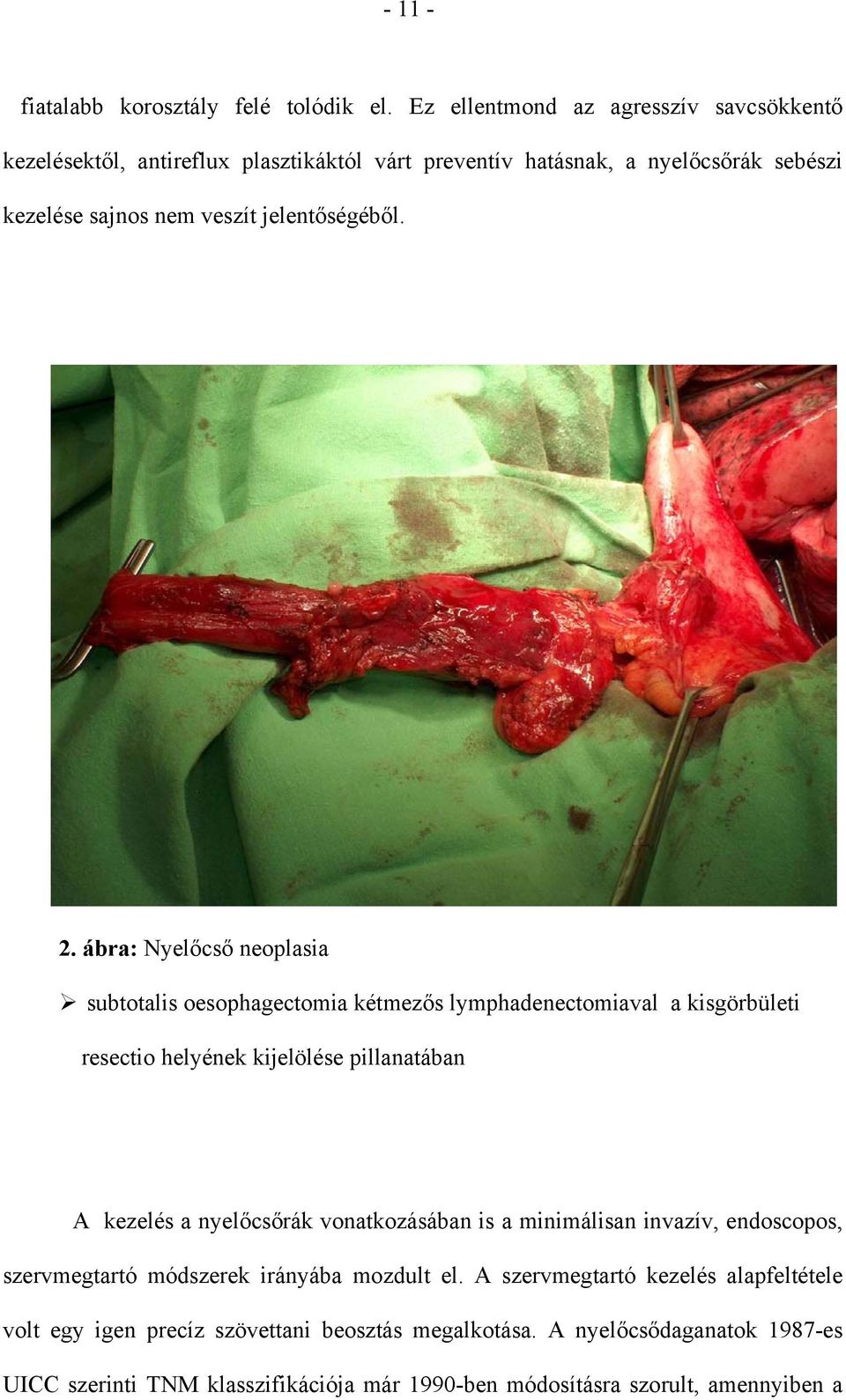 2. ábra: Nyelőcső neoplasia subtotalis oesophagectomia kétmezős lymphadenectomiaval a kisgörbületi resectio helyének kijelölése pillanatában A kezelés a nyelőcsőrák