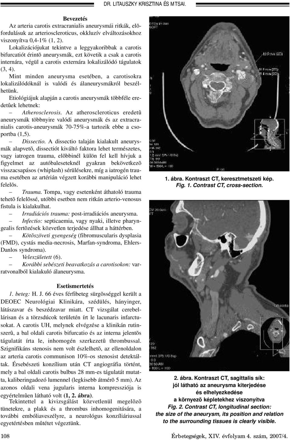 Mint minden aneurysma esetében, a carotisokra lokalizálódóknál is valódi és álaneurysmákról beszélhetünk. Etiológiájuk alapján a carotis aneurysmák többféle eredetûek lehetnek: Atherosclerosis.