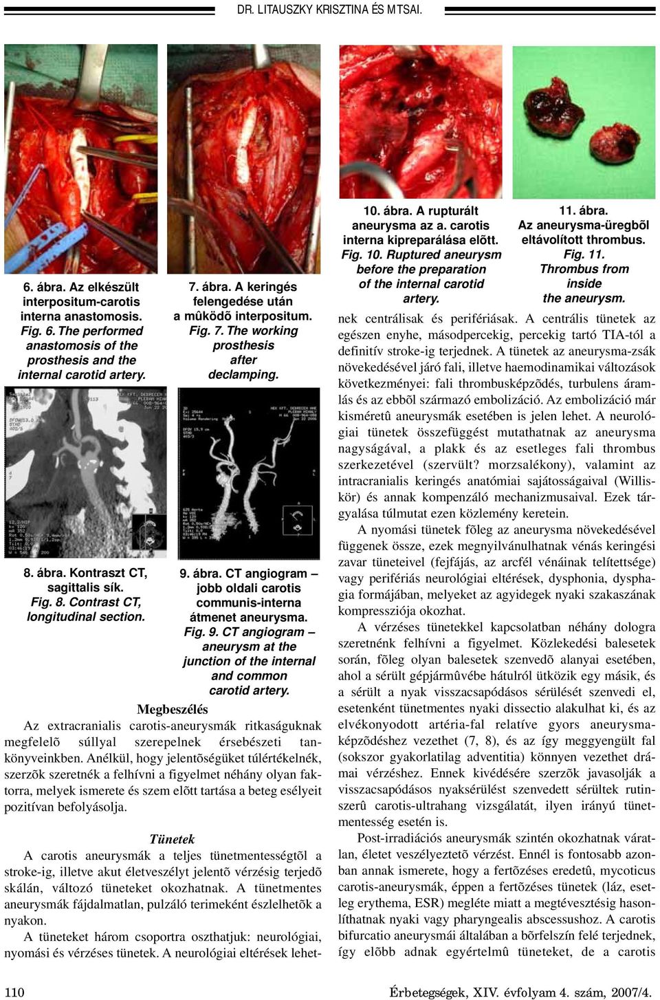 Fig. 9. CT angiogram aneurysm at the junction of the internal and common carotid artery.