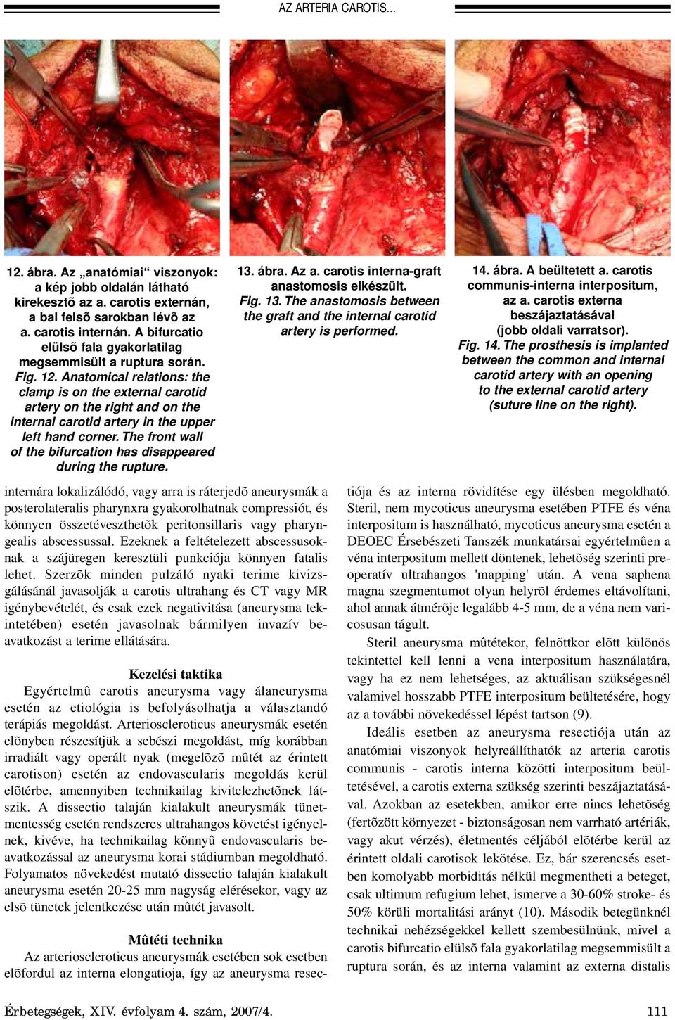 Anatomical relations: the clamp is on the external carotid artery on the right and on the internal carotid artery in the upper left hand corner.