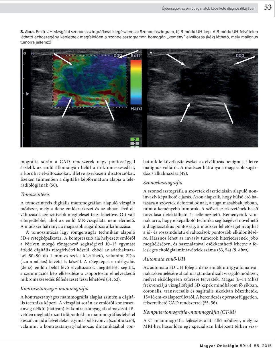 észlelik z emlő állományán elül mikromeszesedést, körülírt elváltozásokt, illetve szerkezeti disztorziókt. Ezeken túlmenően digitális képformátum lpj telerdiológiánk (50).