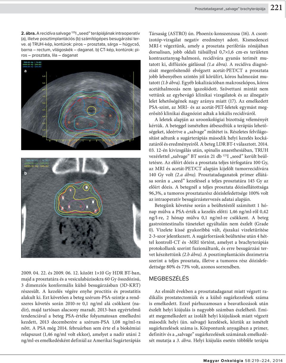 között 1 10 Gy HDR BT-ban, majd a prosztatára és a vesiculabázisokra 60 Gy összdózisú, 3 dimenziós konformális külső besugárzásban (3D-KRT) részesült.