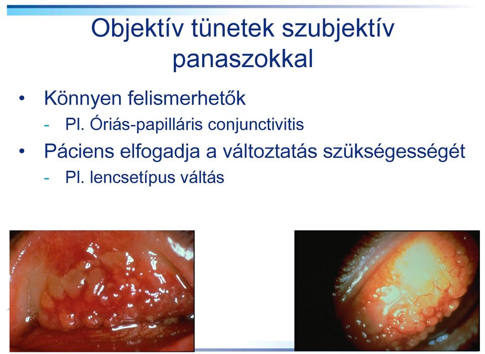 Óriás-papilláris conjunctivitis Páciens