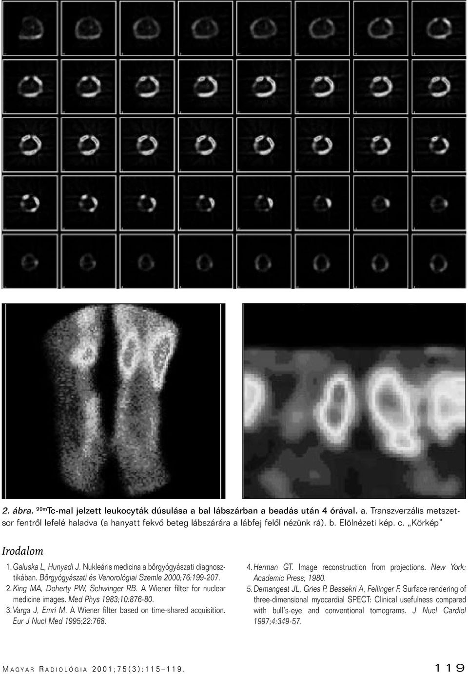 A Wiener filter for nuclear medicine images. Med Phys 1983;10:876-80. 3. Varga J, Emri M. A Wiener filter based on time-shared acquisition. Eur J Nucl Med 1995;22:768. 4. Herman GT.