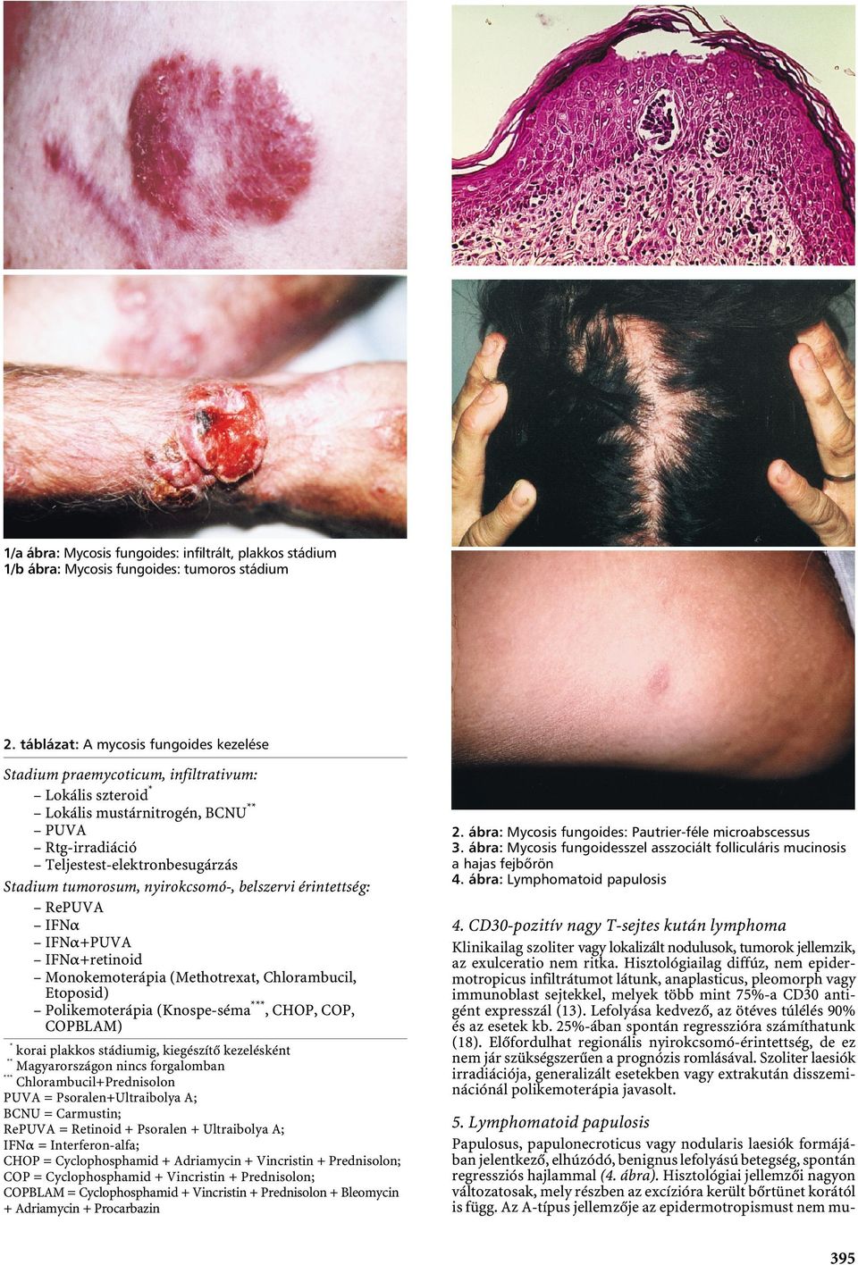 nyirokcsomó-, belszervi érintettség: RePUVA IFNα IFNα+PUVA IFNα+retinoid Monokemoterápia (Methotrexat, Chlorambucil, Etoposid) Polikemoterápia (Knospe-séma***, CHOP, COP, COPBLAM) *** korai plakkos