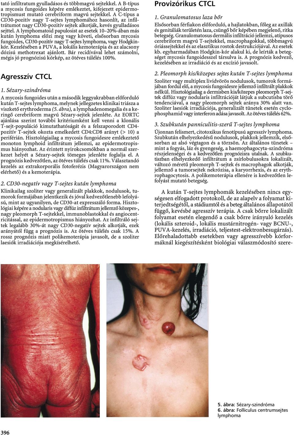 A lymphomatoid papulosist az esetek 10 20%-ában más kután lymphoma előzi meg vagy követi, elsősorban mycosis fungoides, CD30-pozitív nagy T-sejtes lymphoma, vagy Hodgkinkór.