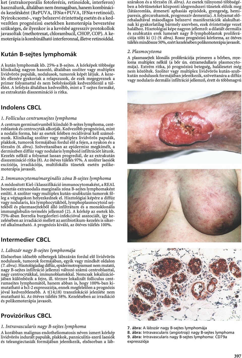 chlorambucil, CHOP, COP). A kemoterápia is kombinálható interferonnal, illetve retinoiddal. szárakon és a törzsön (8. ábra).