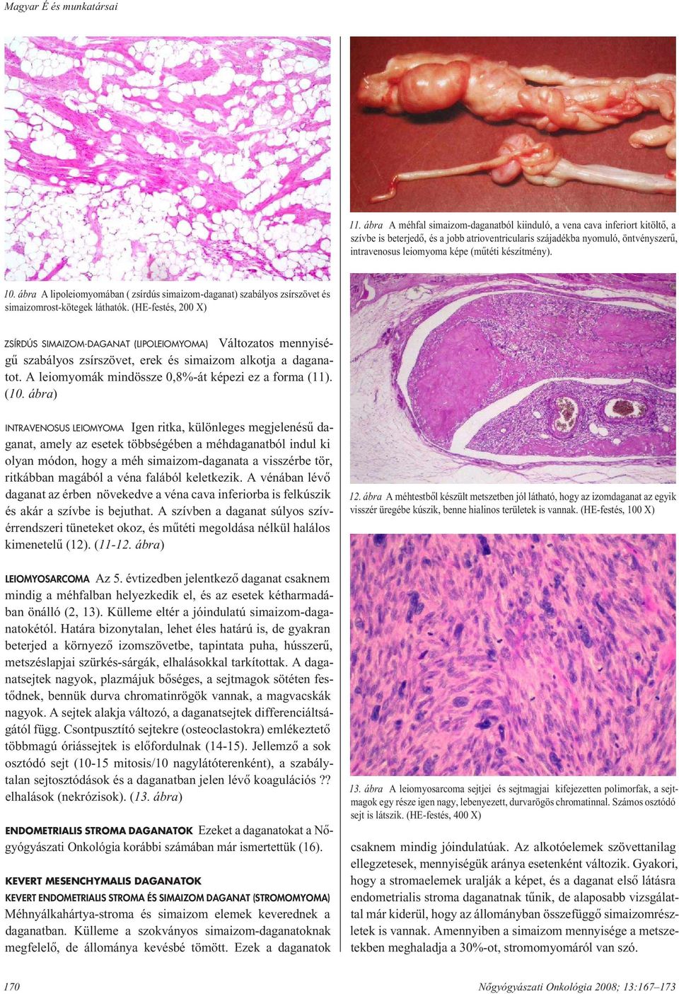 készítmény). 10. ábra A lipoleiomyomában ( zsírdús simaizom-daganat) szabályos zsírszövet és simaizomrost-kötegek láthatók.