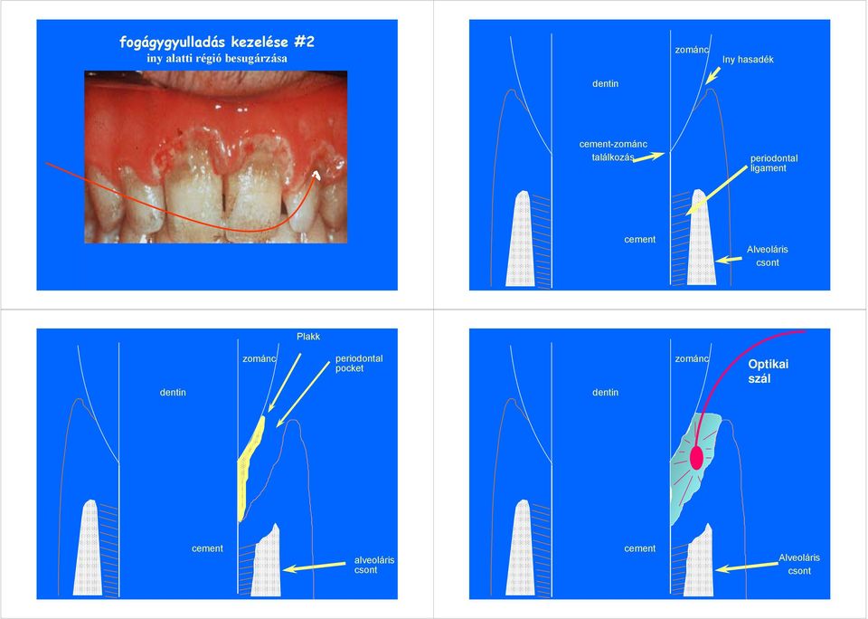 cement Alveoláris csont Plakk dentin zománc periodontal pocket