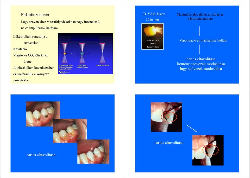 és CO 2 tölti ki az üreget A lökéshullám következtében ez szétáramlik a környező szövetekbe Er:YAG lézer 2940 nm