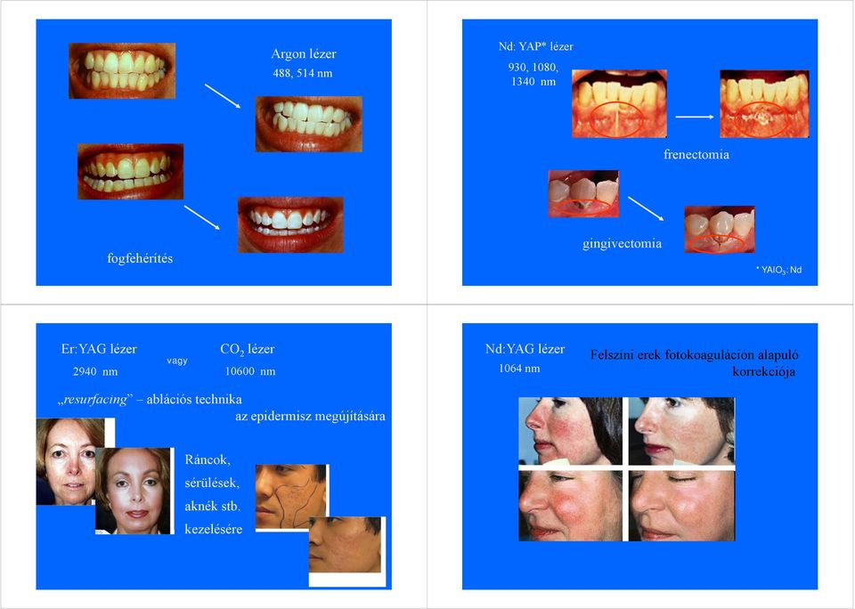 10600 nm Nd:YAG lézer 1064 nm Felszíni erek fotokoaguláción alapuló korrekciója