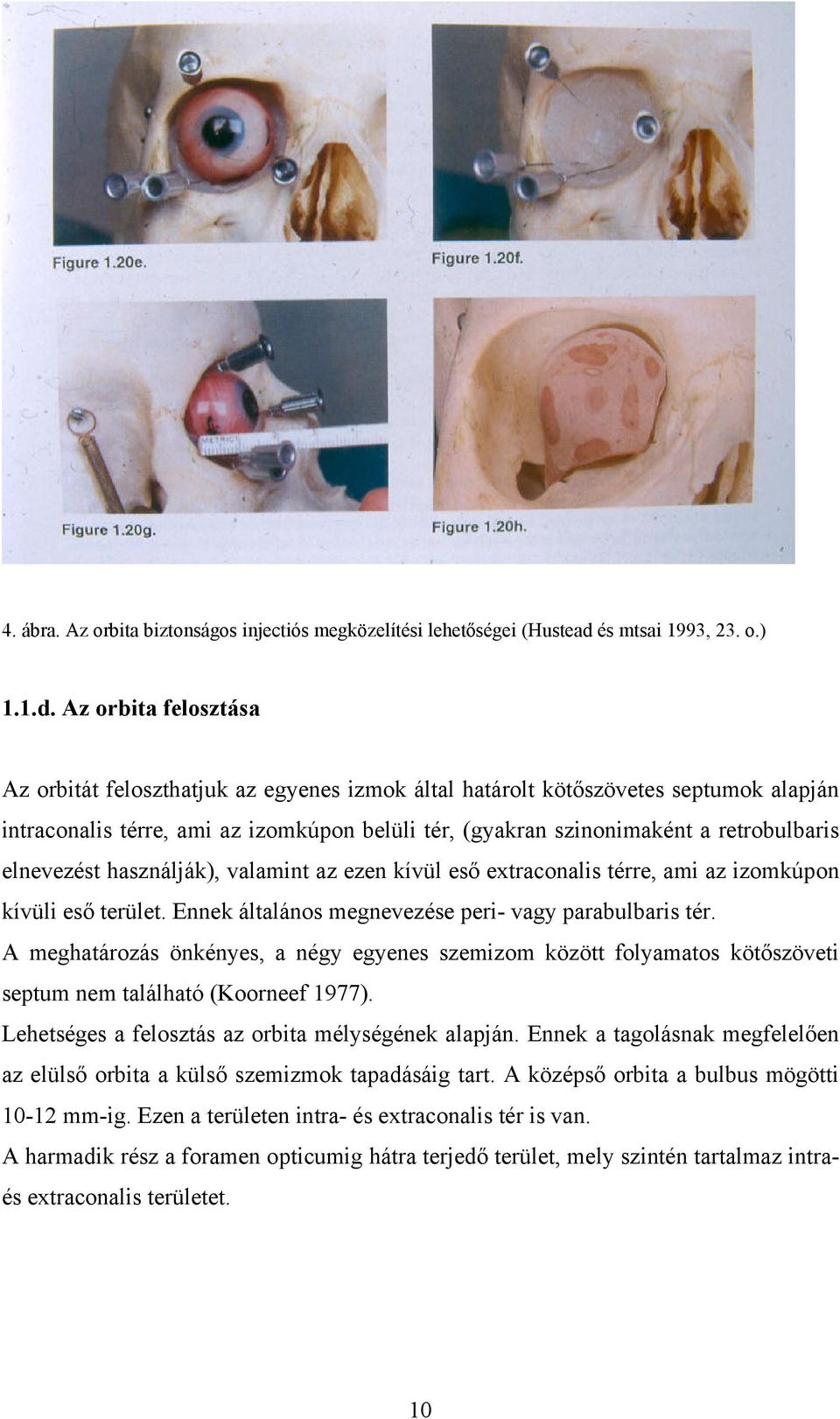 Az orbita felosztása Az orbitát feloszthatjuk az egyenes izmok által határolt kötőszövetes septumok alapján intraconalis térre, ami az izomkúpon belüli tér, (gyakran szinonimaként a retrobulbaris