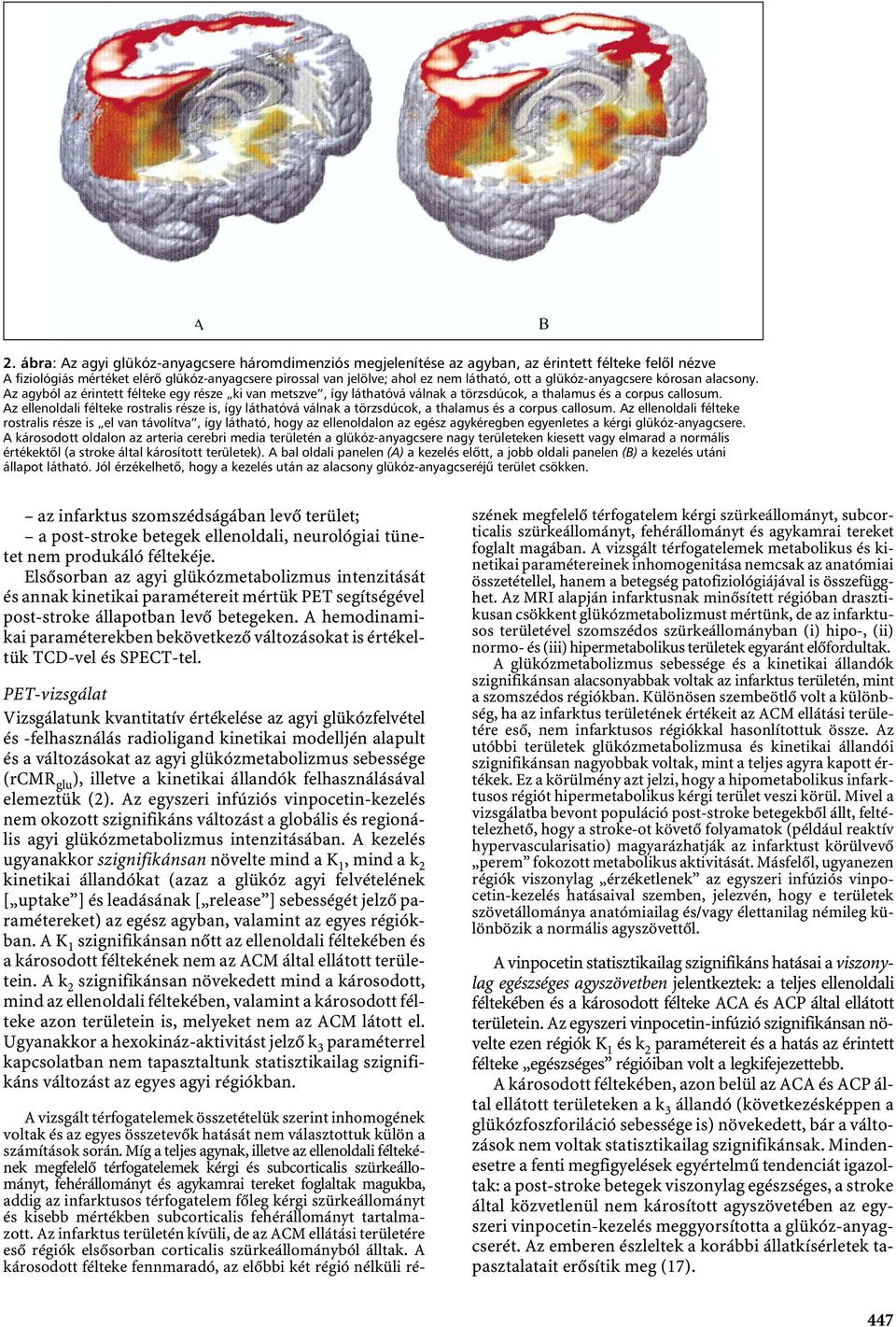 Az ellenoldali félteke rostralis része is, így láthatóvá válnak a törzsdúcok, a thalamus és a corpus callosum.