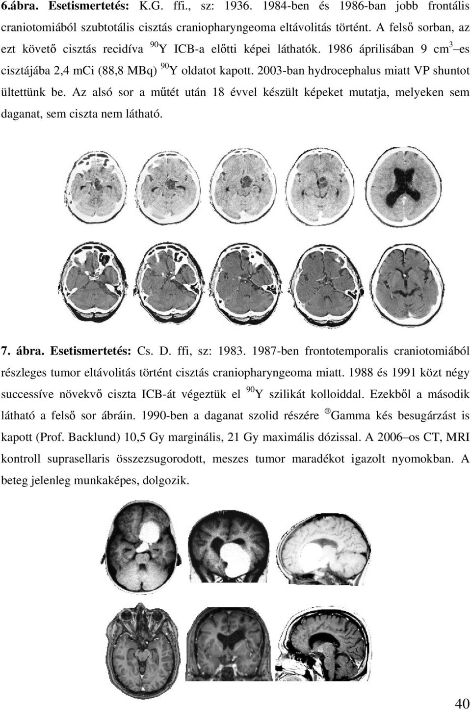 2003-ban hydrocephalus miatt VP shuntot ültettünk be. Az alsó sor a m tét után 18 évvel készült képeket mutatja, melyeken sem daganat, sem ciszta nem látható. 7. ábra. Esetismertetés: Cs. D.