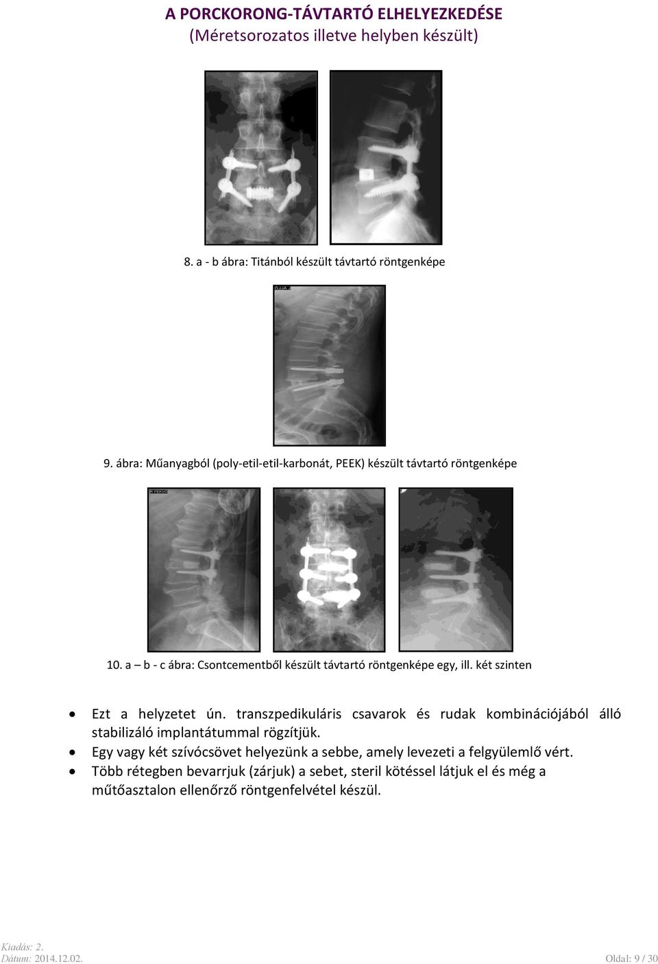 két szinten Ezt a helyzetet ún. transzpedikuláris csavarok és rudak kombinációjából álló stabilizáló implantátummal rögzítjük.