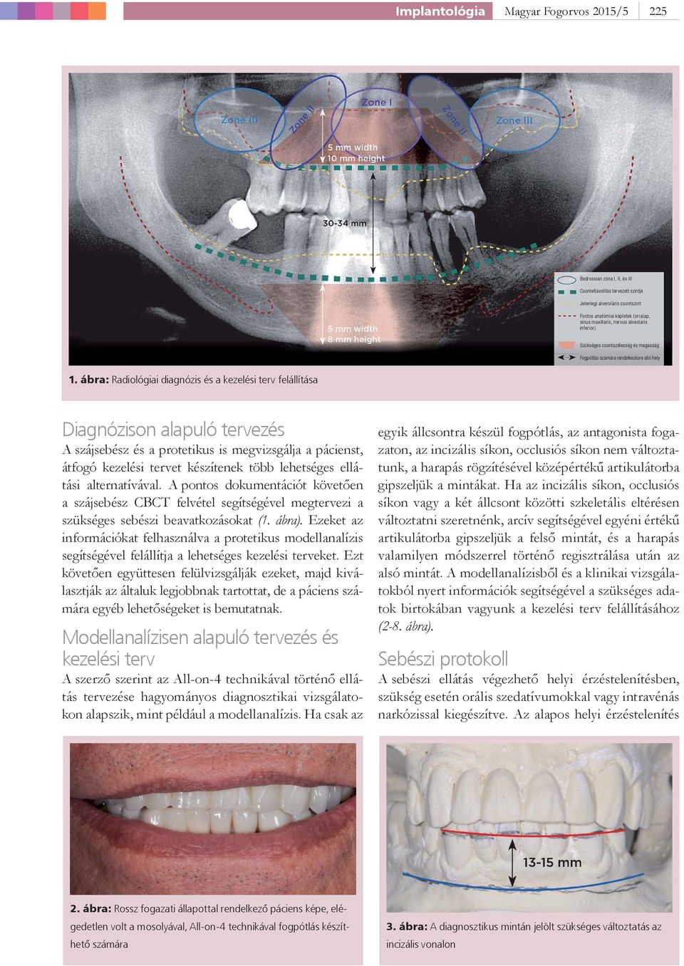 ábra: Radiológiai diagnózis és a kezelési terv felállítása Diagnózison alapuló tervezés A szájsebész és a protetikus is megvizsgálja a pácienst, átfogó kezelési tervet készítenek több lehetséges