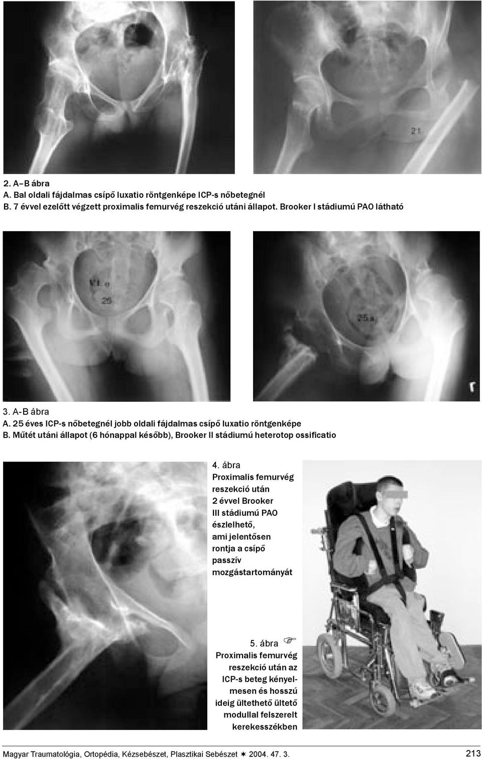 Műtét utáni állapot (6 hónappal később), Brooker II stádiumú heterotop ossificatio 4.