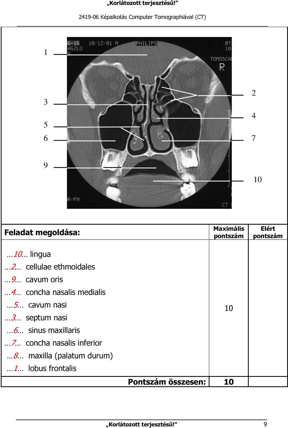 nasi 3 septum nasi 6 sinus maxillaris 7 concha nasalis inferior 8 maxilla (palatum