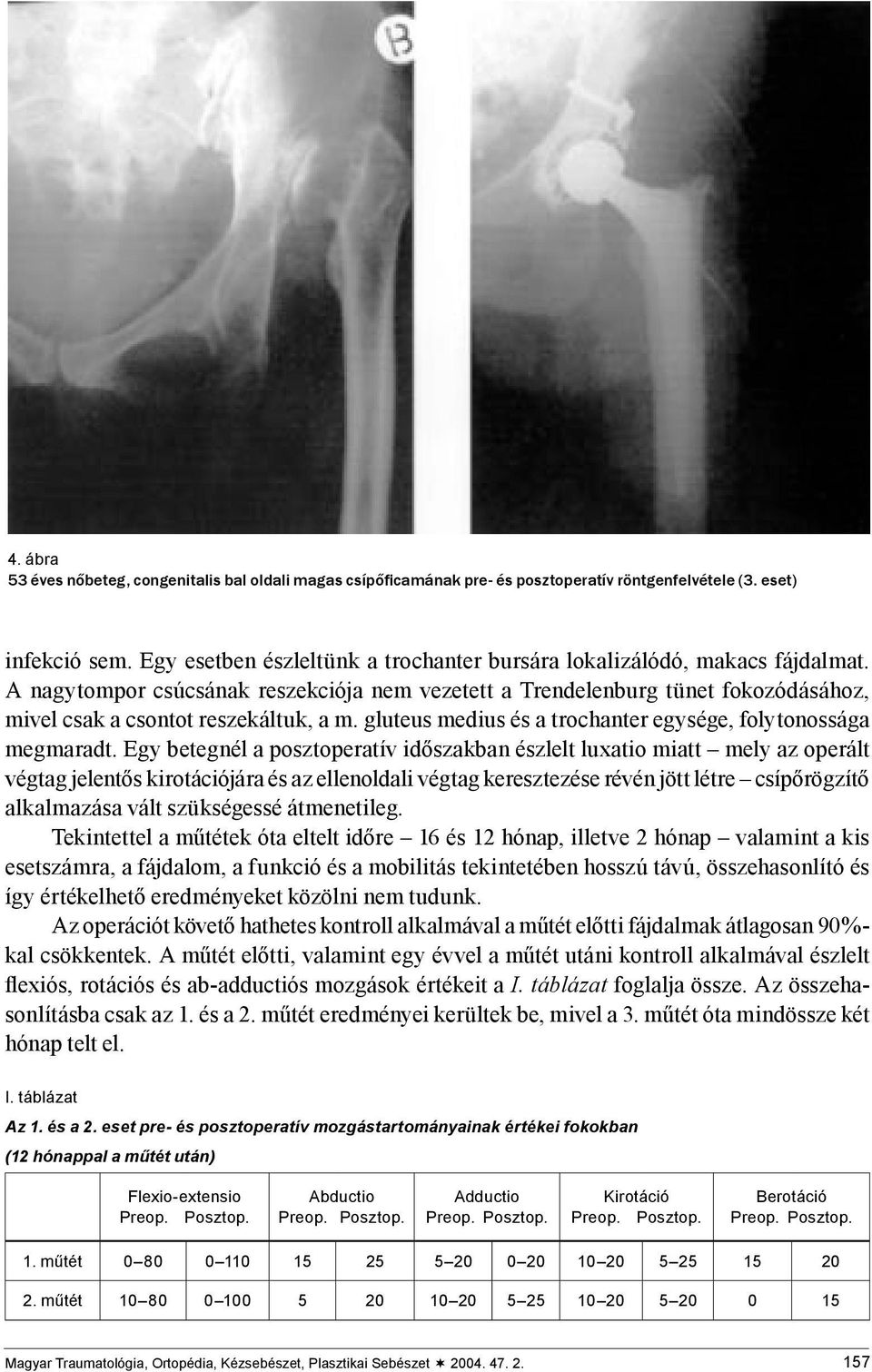 gluteus medius és a trochanter egysége, folytonossága megmaradt.