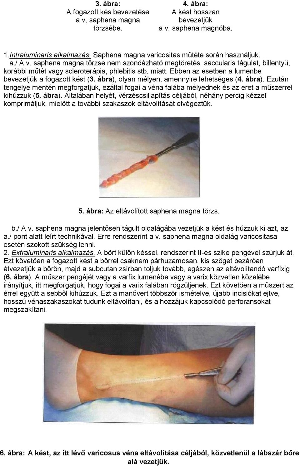 Ebben az esetben a lumenbe bevezetjük a fogazott kést (3. ábra), olyan mélyen, amennyire lehetséges (4. ábra). Ezután tengelye mentén megforgatjuk, ezáltal fogai a véna falába mélyednek és az eret a műszerrel kihúzzuk (5.