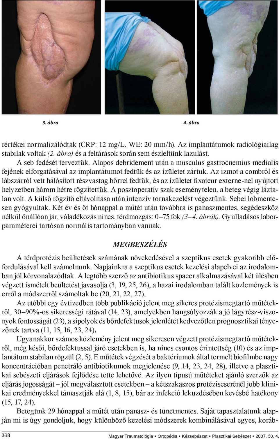 Az izmot a combról és lábszárról vett hálósított részvastag bőrrel fedtük, és az ízületet fixateur externe-nel nyújtott helyzetben három hétre rögzítettük.