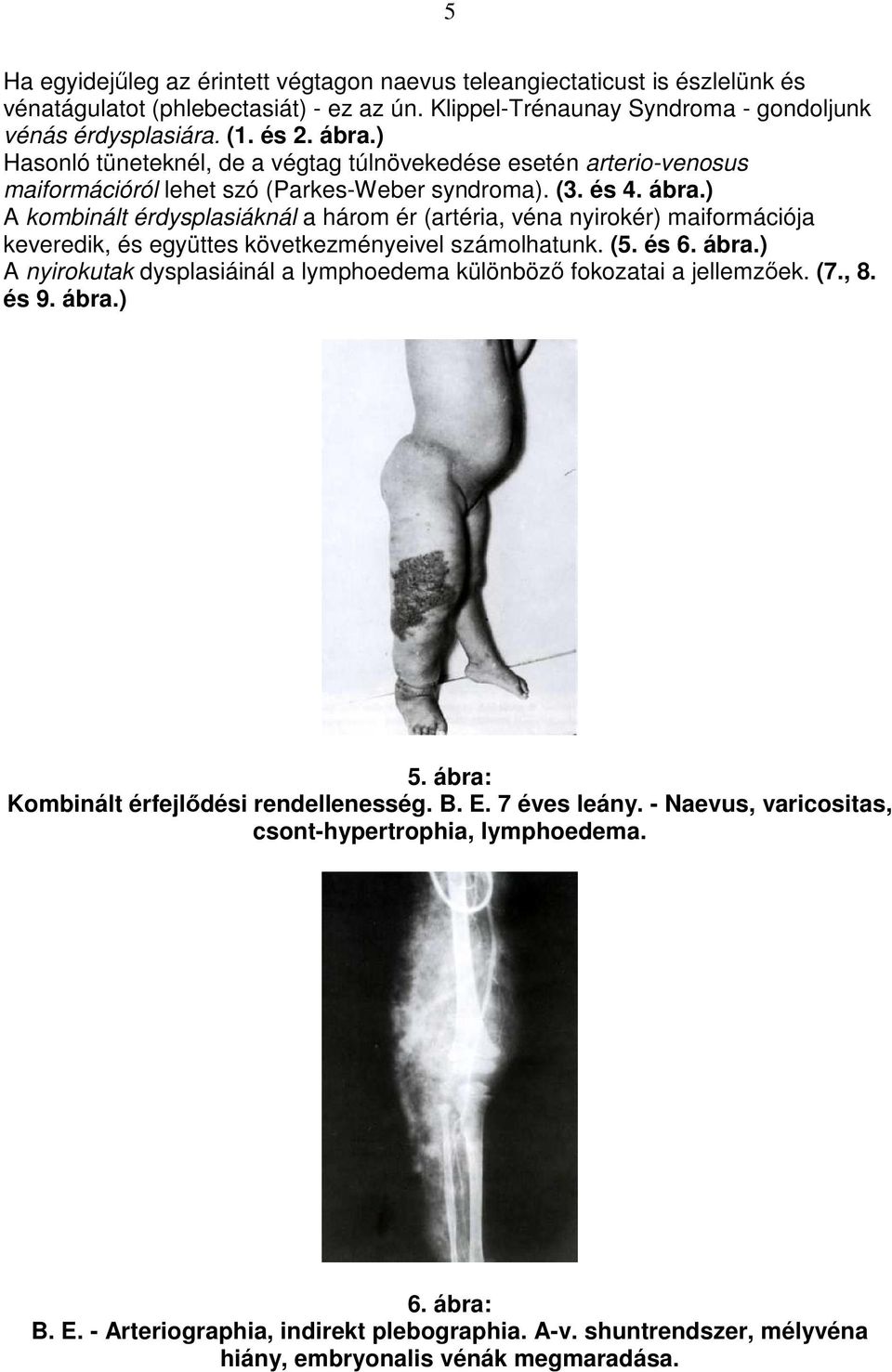 ) A kombinált érdysplasiáknál a három ér (artéria, véna nyirokér) maiformációja keveredik, és együttes következményeivel számolhatunk. (5. és 6. ábra.