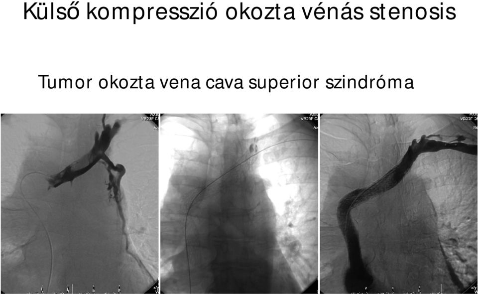 stenosis Tumor