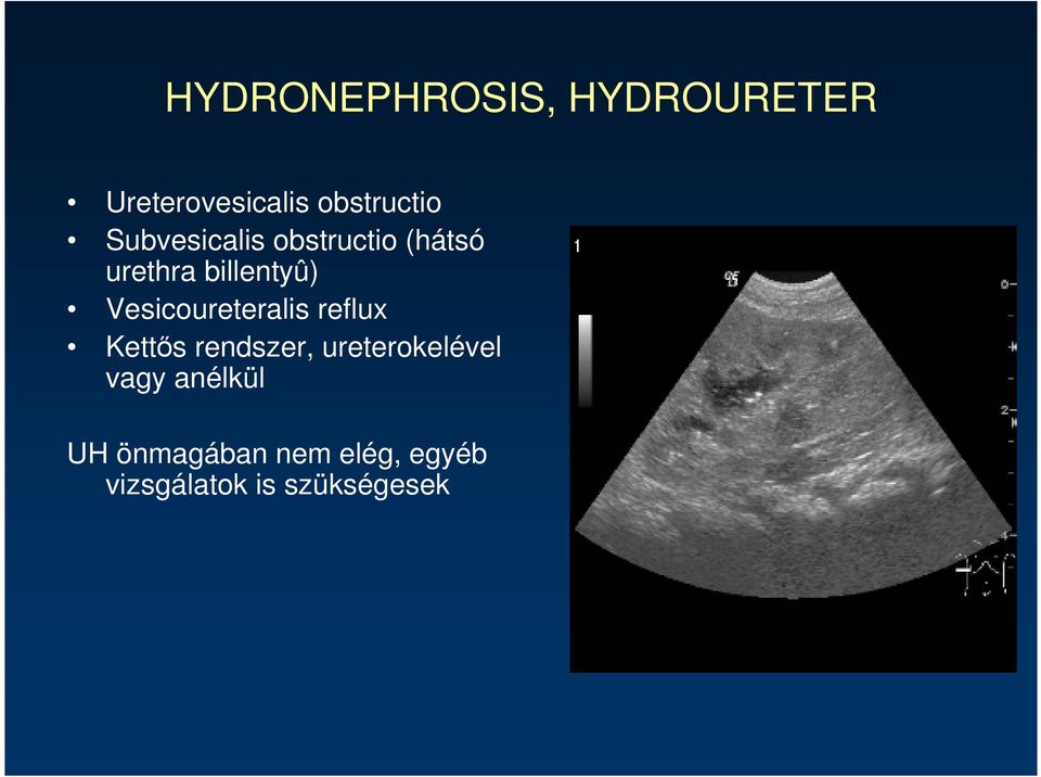 Vesicoureteralis reflux Kettıs rendszer, ureterokelével