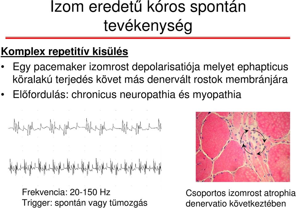 rostok membránjára Előfordulás: chronicus neuropathia és myopathia Frekvencia: