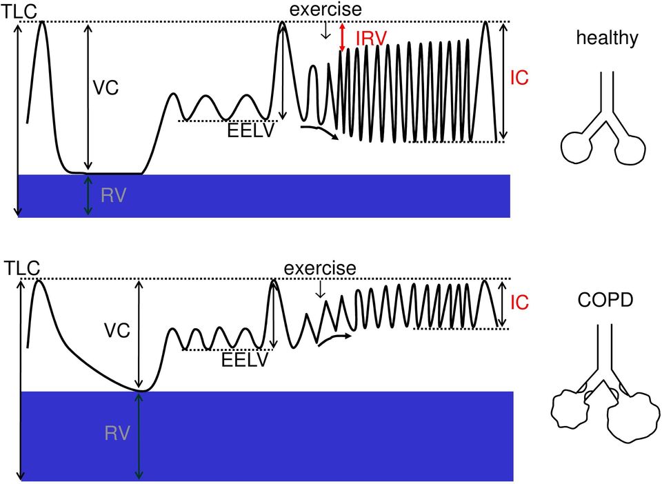 EELV RV TLC VC