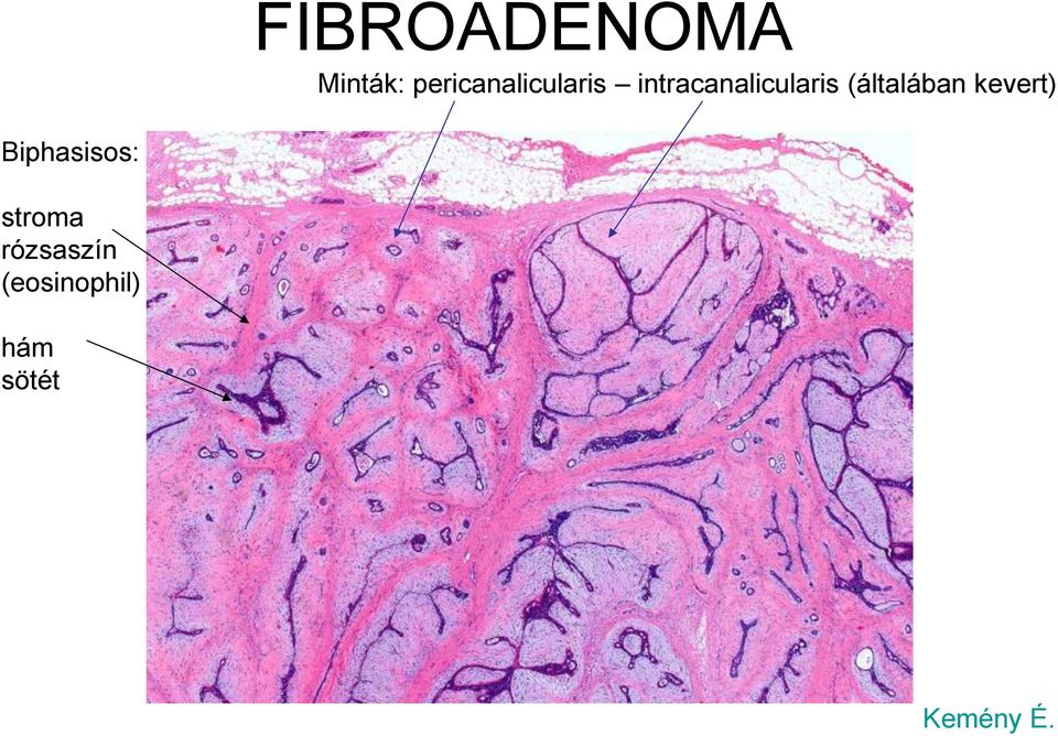 intracanalicularis (általában