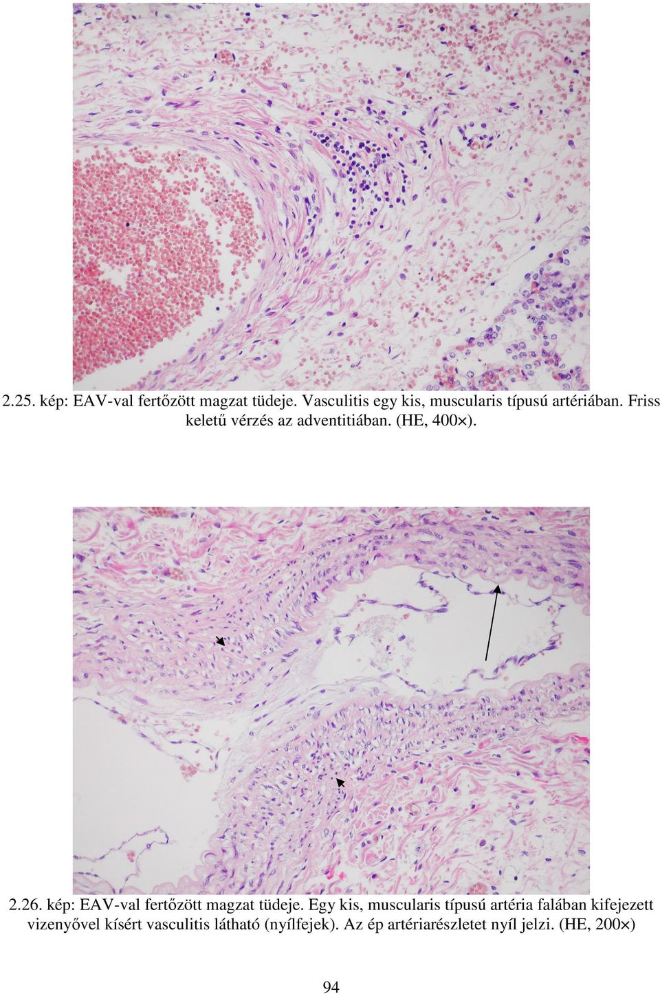 Friss keletű vérzés az adventitiában. (HE, 400 ). 2.26.