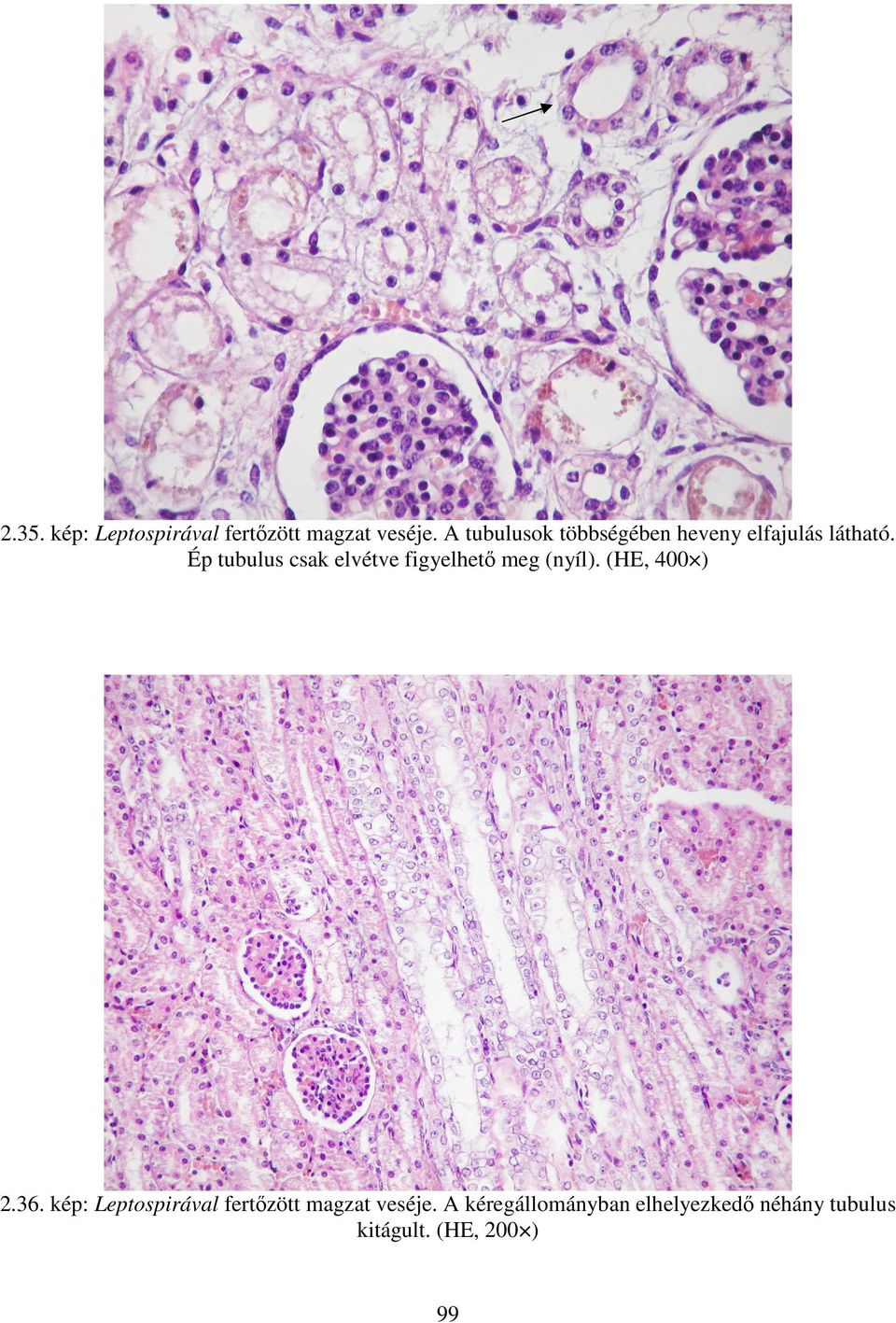 Ép tubulus csak elvétve figyelhető meg (nyíl). (HE, 400 ) 2.36.