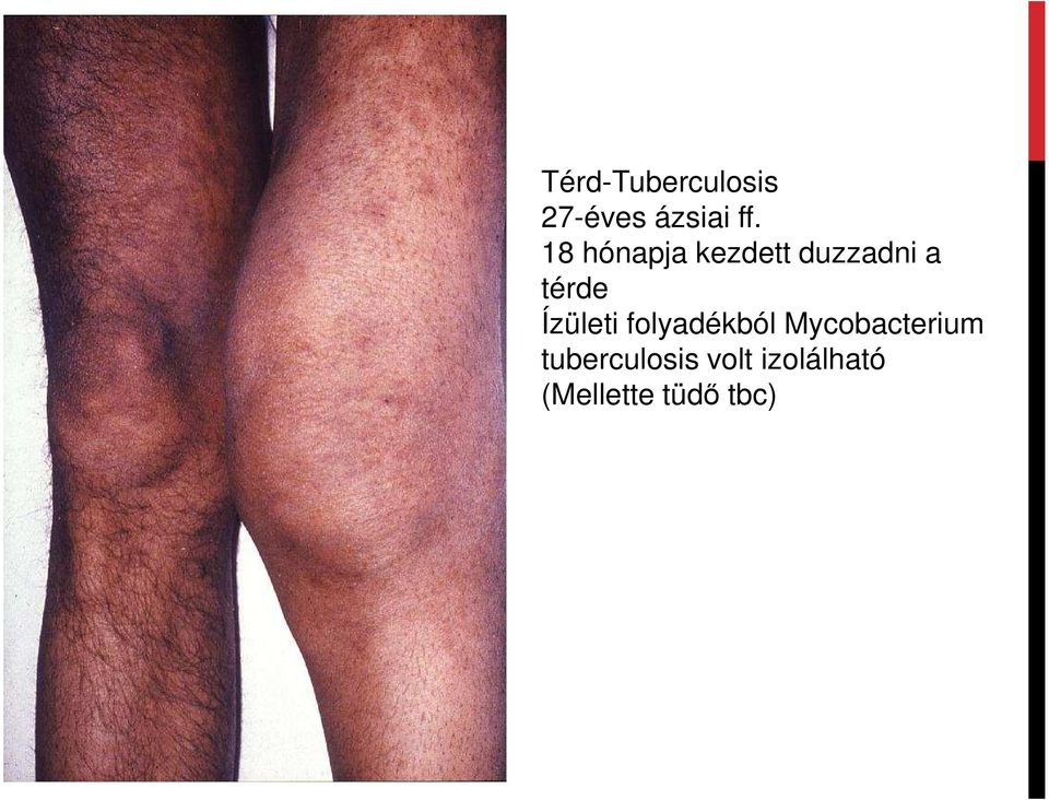 Ízületi folyadékból Mycobacterium