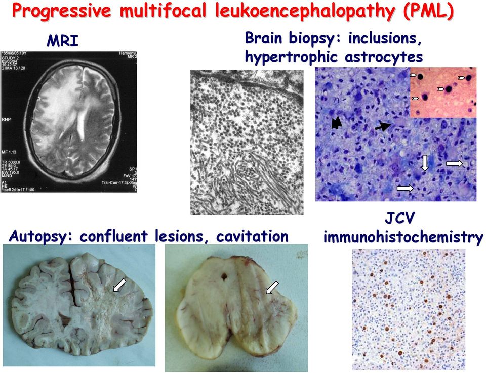 biopsy: inclusions, hypertrophic