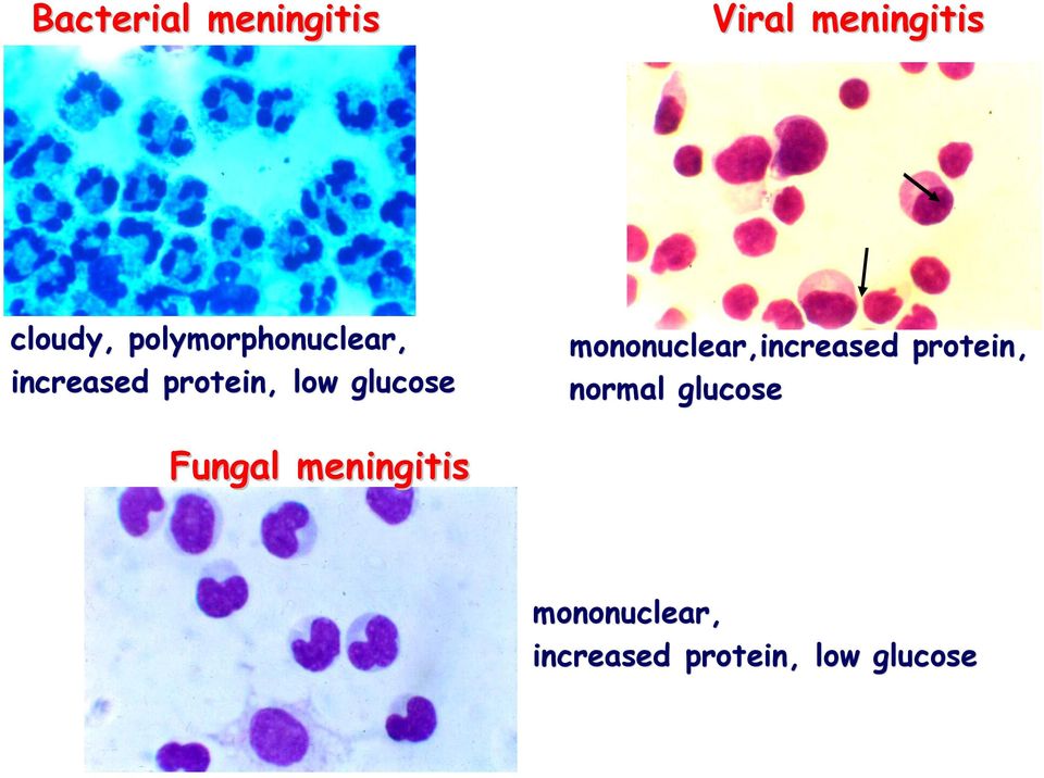 mononuclear,increased protein, normal glucose