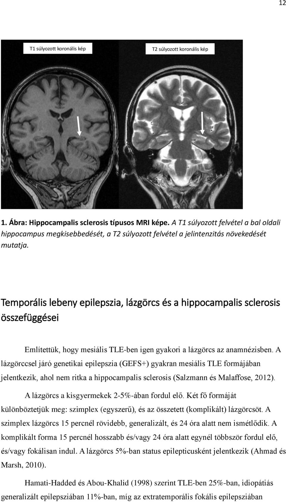 Temporális lebeny epilepszia, lázgörcs és a hippocampalis sclerosis összefüggései Említettük, hogy mesiális TLE-ben igen gyakori a lázgörcs az anamnézisben.