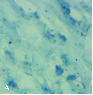 10. ábra Foszfolipid az artériás trombusban. Arteria femoralis-ból eltávolított trombus (A) vagy 5 g/l foszfolipid tartalmú fibrin (B) fagyasztott metszetét foszfolipidre festettük Nílus-kékkel.