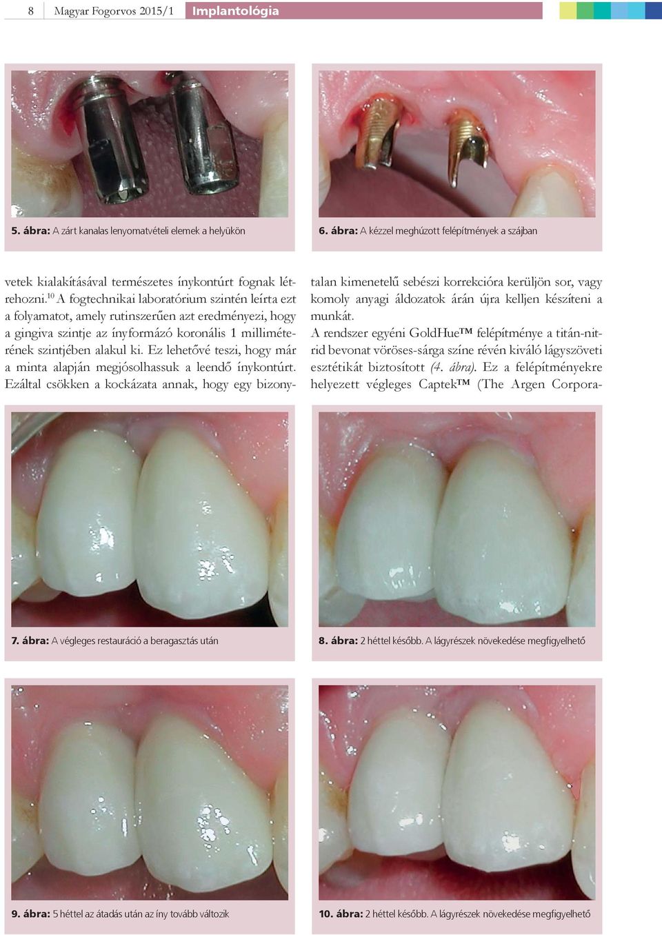 10 A fogtechnikai laboratórium szintén leírta ezt a folyamatot, amely rutinszerűen azt eredményezi, hogy a gingiva szintje az ínyformázó koronális 1 milliméterének szintjében alakul ki.