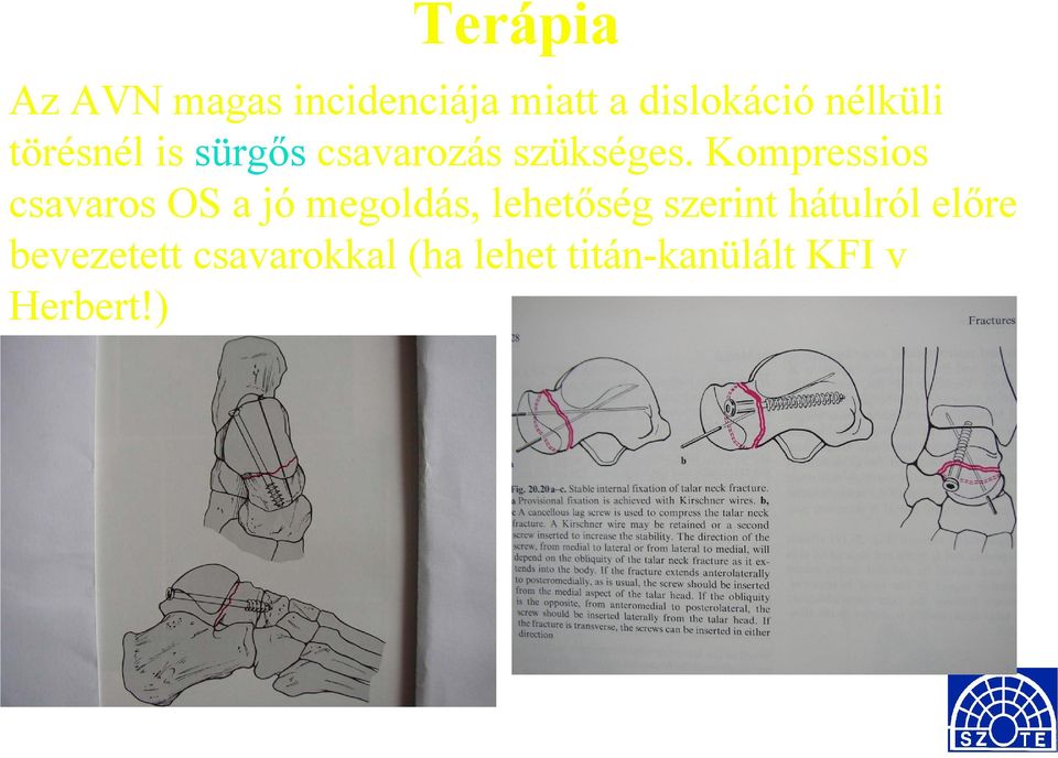 Kompressios csavaros OS a jó megoldás, lehetőség szerint