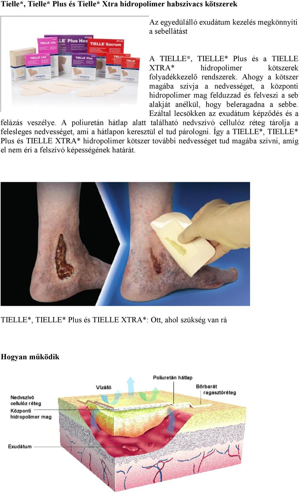 Ezáltal lecsökken az exudátum képződés és a felázás veszélye. A poliuretán hátlap alatt található nedvszívó cellulóz réteg tárolja a felesleges nedvességet, ami a hátlapon keresztül el tud párologni.