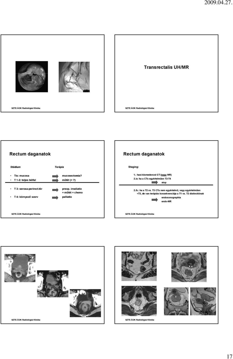/a: ha a CTs egyértelműen T3-T4 T4 stop T 3: serosa-perirect.tér T 4: környező szerv preop.