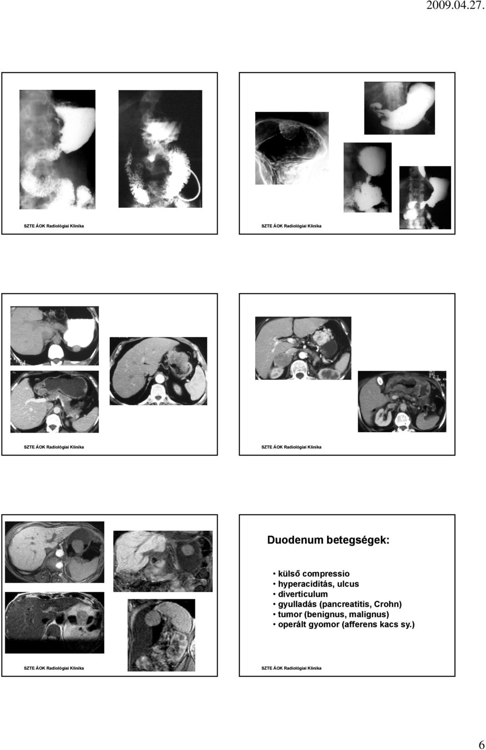 gyulladás (pancreatitis, Crohn) tumor