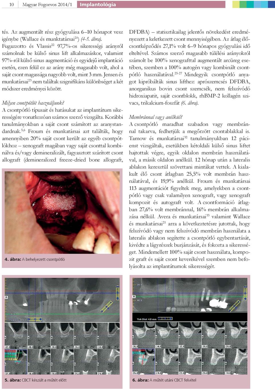 magasabb volt, ahol a saját csont magassága nagyobb volt, mint 3 mm. Jensen és munkatársai 23 nem találtak szignifikáns különbséget a két módszer eredményei között. Milyen csontpótlót használjunk?